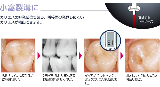 香川県 高松市 浮田歯科医院 歯質の状態を敏感に検知する2つのアプローチ