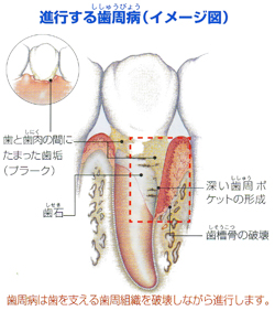 進行する歯周病